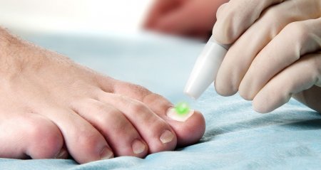 Симптомы, причины и лечение грибка ногтей